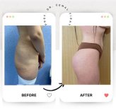 Vorher-nachher-Ergebnisse Brazilian Butt Lift im Medical Park Antalya Hospital Complex