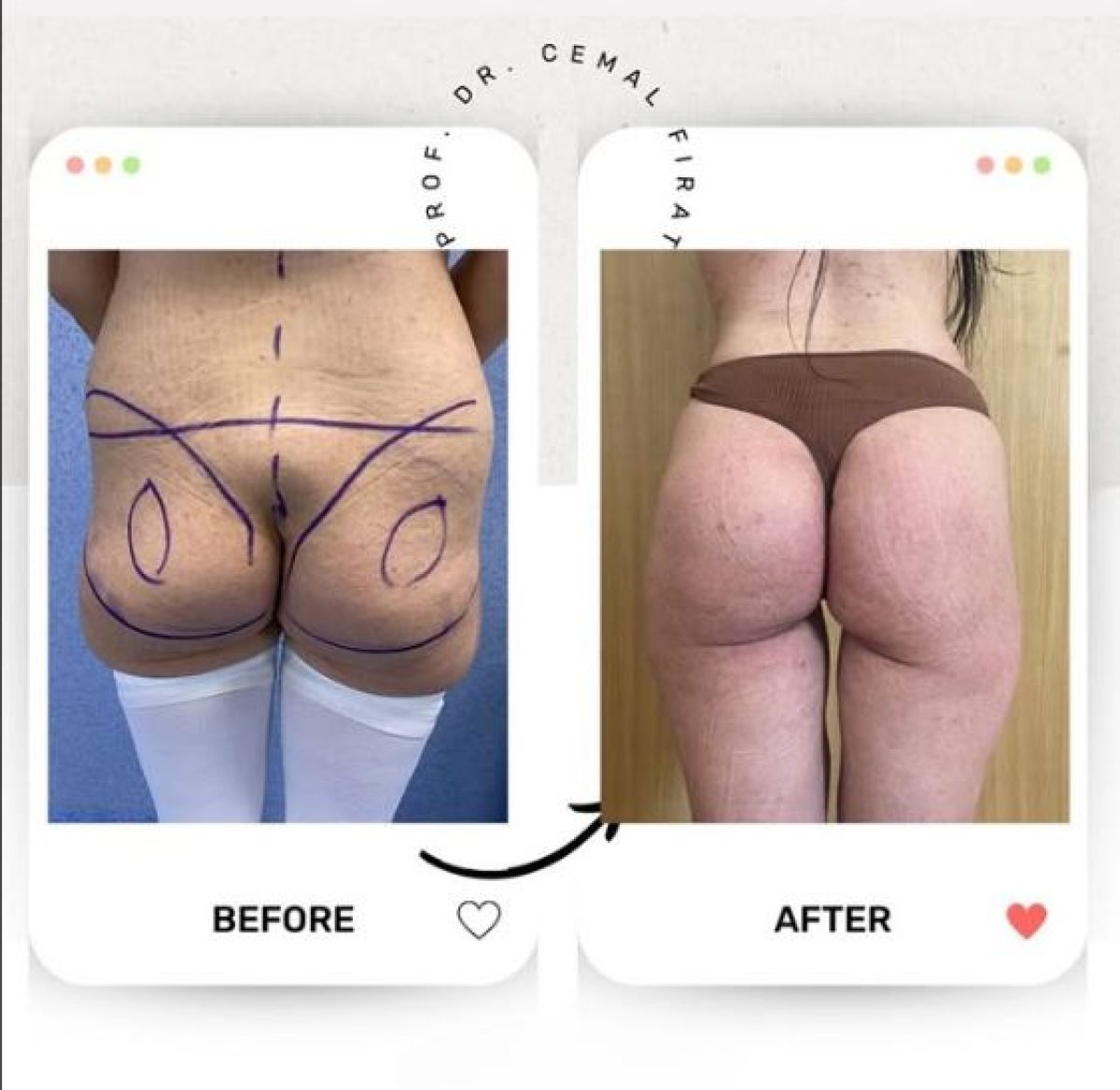 نتائج قبل وبعد عملية Brazilian Butt Lift في Medical Park Antalya Hospital Complex