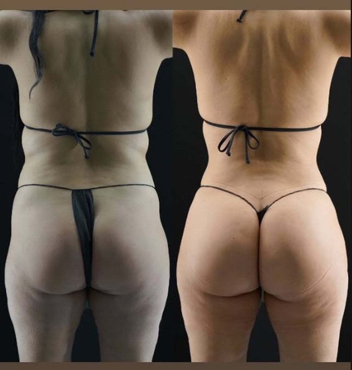 نتائج قبل وبعد عملية Brazilian Butt Lift في Medical Park Antalya Hospital Complex