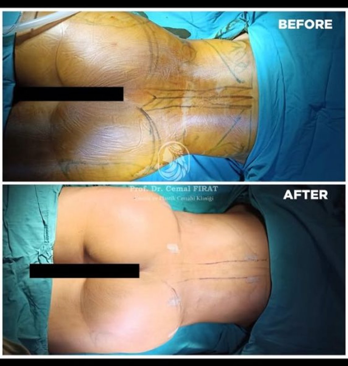 نتائج قبل وبعد عملية Brazilian Butt Lift في Medical Park Antalya Hospital Complex