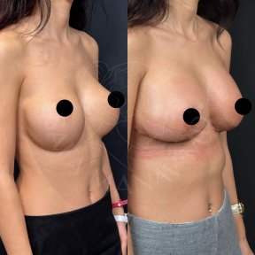 Vorher-nachher-Ergebnis Brustimplantate mit Straffung bei Dr. Safa Manav Clinic, verbesserte Form