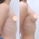 До та після збільшення грудей у Wansiri Hospital, помітний результат