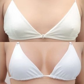 До і після збільшення грудей у Wansiri Hospital, результат покращення форми і розміру