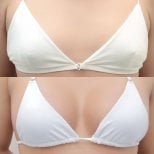 До і після збільшення грудей у Wansiri Hospital, результат покращення форми і розміру