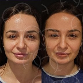 Before and after endoscopic facelift results at Dr. Safa Manav Clinic, facial rejuvenation