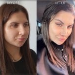 Before and after endoscopic facelift results at Dr. Safa Manav Clinic, facial rejuvenation