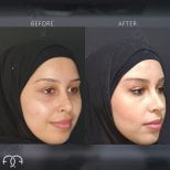 Endoscopic facelift before and after results at Dr. Safa Manav Clinic, facial rejuvenation