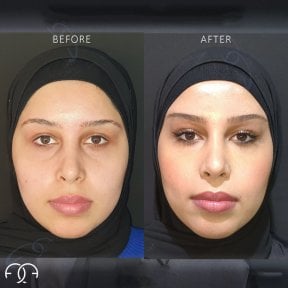 Before and after endoscopic facelift results at Dr. Safa Manav Clinic, facial rejuvenation