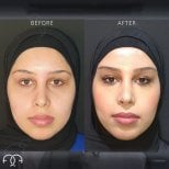 Before and after endoscopic facelift results at Dr. Safa Manav Clinic, facial rejuvenation