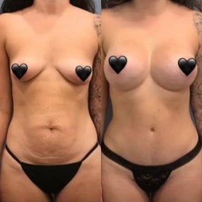 Vorher-nachher-Ergebnis Brustvergrößerung bei Istanbul Aesthetic Plastic Surgery Center