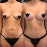 Vorher-nachher-Ergebnis Brustvergrößerung bei Istanbul Aesthetic Plastic Surgery Center