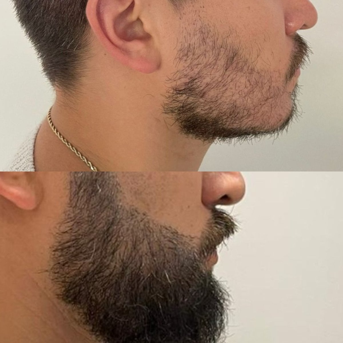 Resultado de trasplante de barba antes y después en Hair In 1 Day Mexico City, barba más densa