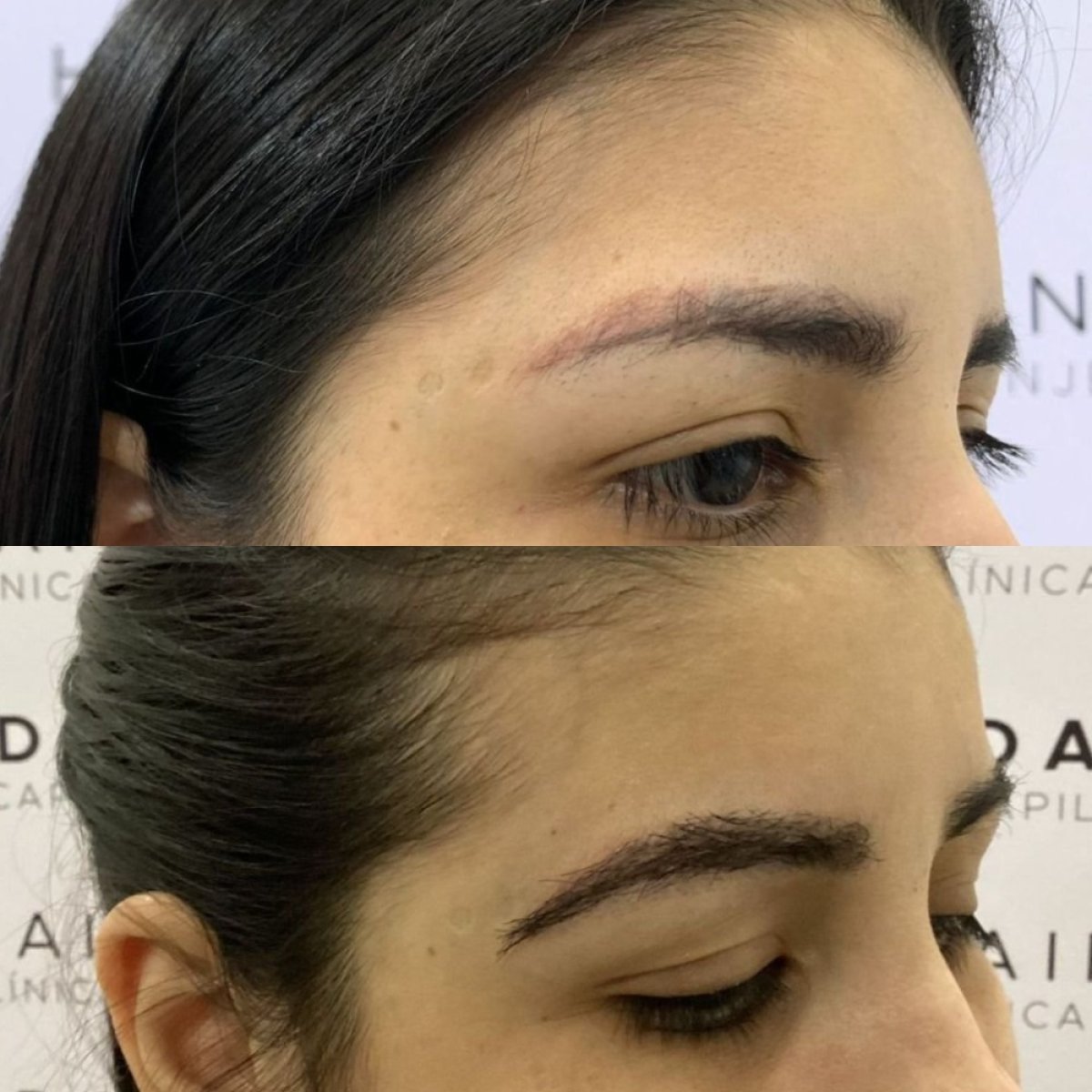 نتائج قبل وبعد زراعة الحواجب في Hair In 1 Day Monterrey، حواجب أكثر كثافة