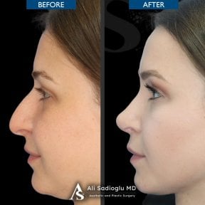Résultats avant et après rhinoplastie à la clinique Dr. Safa Manav, profil du nez amélioré