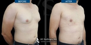 Фото до и после открытой ринопластики, доктор 