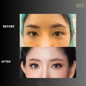 Upper eyelid surgery before and after results at ID Clinic Bangkok – brighter eye appearance