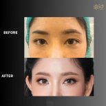 Upper eyelid surgery before and after results at ID Clinic Bangkok – brighter eye appearance