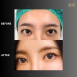 Before and after upper eyelid surgery results at ID Clinic Bangkok, improved eye appearance