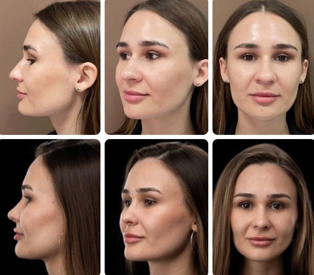 Resultados de rinoplastia antes y después en Yurchenko Plastic Surgery Team, remodelación nasal