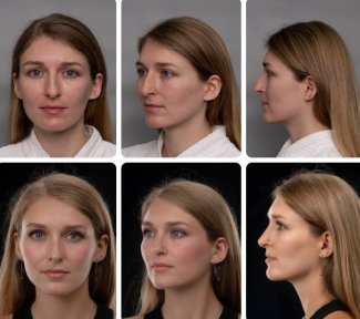 Before and after rhinoplasty results at Yurchenko Plastic Surgery Team, nose reshaping