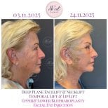 Фото до та після пластики верхньої повіки, доктор 