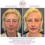 Фото до та після пластики верхньої повіки, доктор 