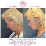 Фото до та після пластики верхньої повіки, доктор 