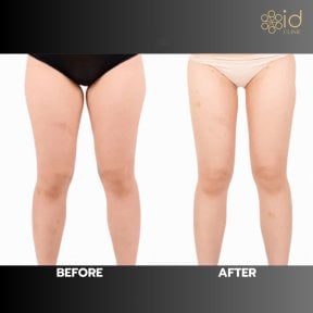 Before and after thigh liposuction results at ID Clinic Bangkok, slimmer leg contour visible