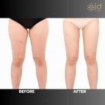 Before and after thigh liposuction results at ID Clinic Bangkok, slimmer leg contour visible