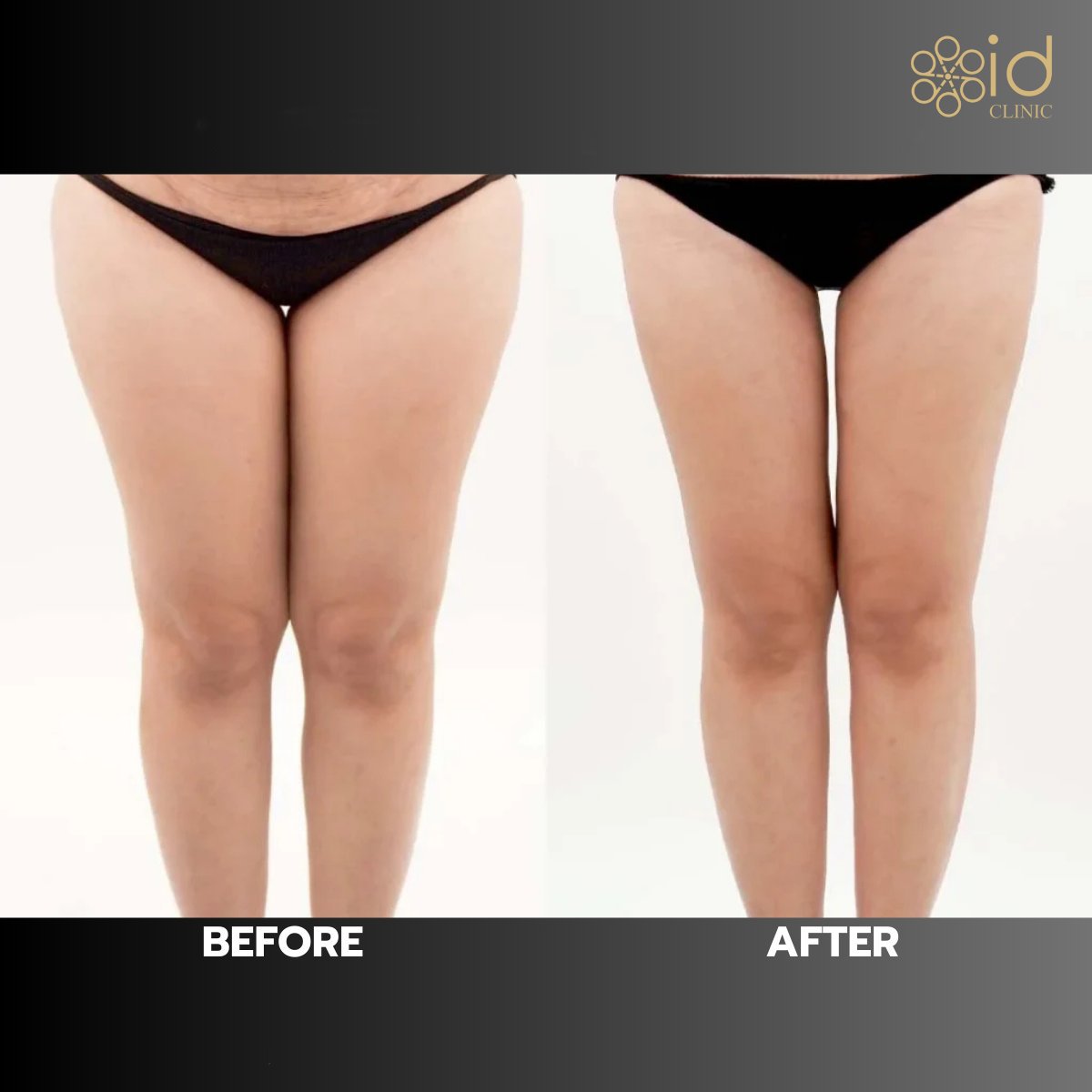 نتائج شفط دهون الفخذين قبل وبعد في ID Clinic Bangkok، مظهر أفخاذ أنحف