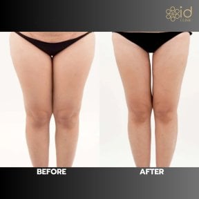 Before and after thigh liposuction results at ID Clinic Bangkok, slimmer leg contour visible