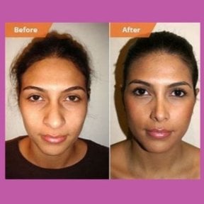 Before and after ethnic rhinoplasty results at ID Clinic Bangkok, nose reshaping outcome