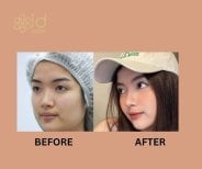 Before and after ethnic rhinoplasty results at ID Clinic Bangkok, nose reshaping outcome