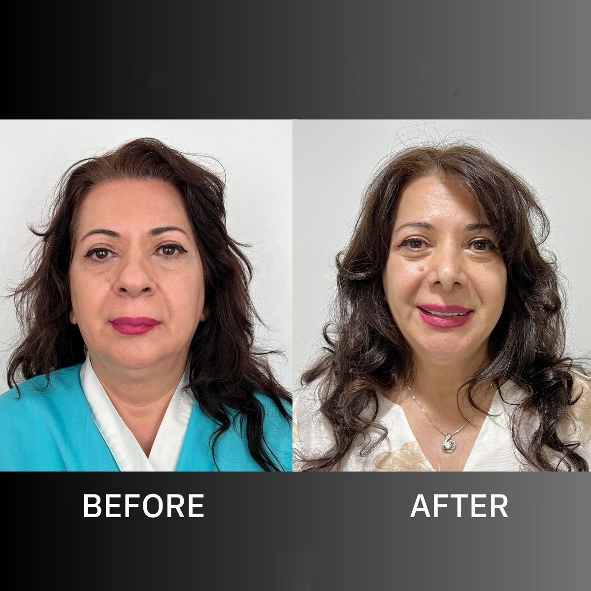 نتائج تجميل الأنف العرقي قبل وبعد في ID Clinic Bangkok، تحسين شكل الأنف