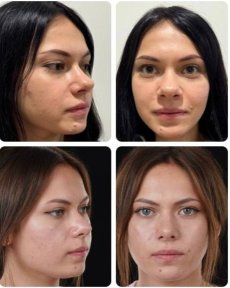 Before and after rhinoplasty results at Yurchenko Plastic Surgery Team, nose reshaping
