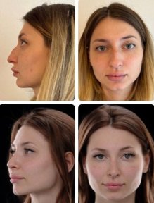 Before and after rhinoplasty results at Yurchenko Plastic Surgery Team, nose reshaping