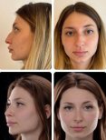 Before and after rhinoplasty results at Yurchenko Plastic Surgery Team, nose reshaping