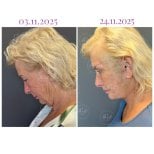 نتائج شد الوجه قبل وبعد في Db'est Clinic – تجديد شباب الوجه وشد البشرة