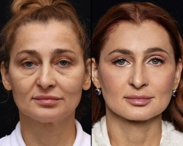Before and after lipofilling results at Vidnova Clinic – facial rejuvenation and volume restoration