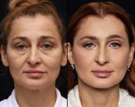 Before and after lipofilling results at Vidnova Clinic – facial rejuvenation and volume restoration