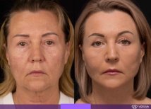 Before and after lipofilling results at Vidnova Clinic – facial rejuvenation and volume restoration