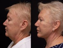 Before and after lipofilling results at Vidnova Clinic – facial contour and skin rejuvenation