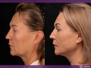 Before and after lipofilling results at Vidnova Clinic – facial rejuvenation and contouring