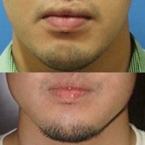 Before and after jaw shaping results at Wansiri Hospital, improved chin and jawline contour