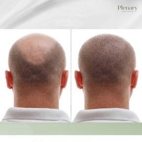 نتائج زراعة الشعر قبل وبعد في Plenary Wellness، كثافة شعر محسنة في التاج