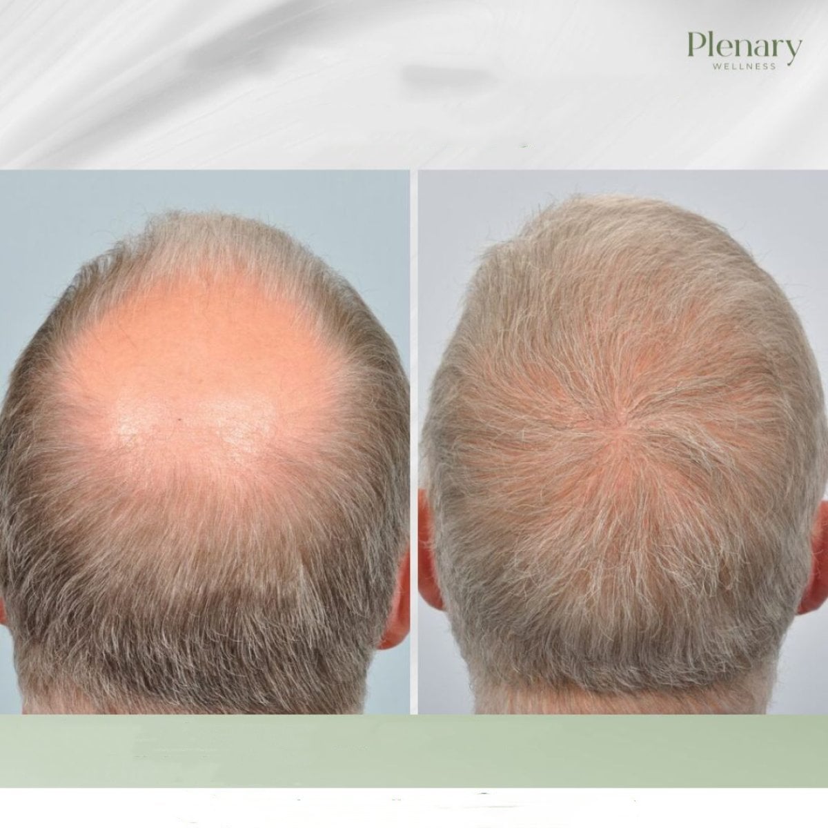 نتائج زراعة الشعر قبل وبعد في Plenary Wellness، استعادة كثافة الشعر في منطقة التاج