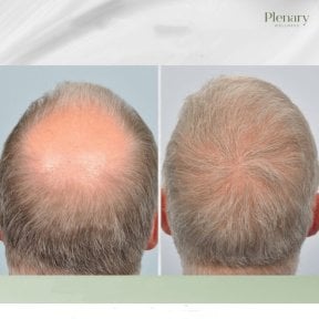 Результати пересадки волосся в Plenary Wellness: відновлення густоти на тімені