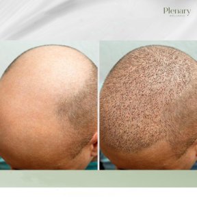 Before and after hair transplant results at Plenary Wellness, visible hair restoration progress