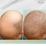 Before and after hair transplant results at Plenary Wellness, visible hair restoration progress