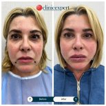 Before and after threads lifting results at CE International Hospital, facial rejuvenation procedure